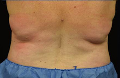 CoolSculpting™ Before