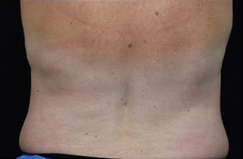 CoolSculpting™ After