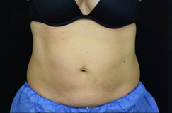 CoolSculpting™ Before