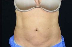 CoolSculpting™ After