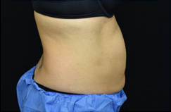 CoolSculpting™ Before