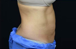 CoolSculpting™ After