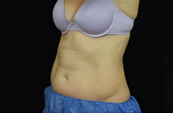 CoolSculpting™ Before