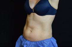 CoolSculpting™ After