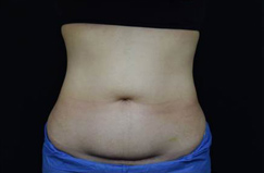 Before CoolSculpting® Results