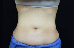 After CoolSculpting® Results