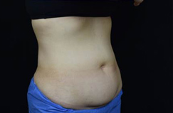 CoolSculpting™ Before