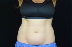 CoolSculpting™ Before