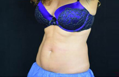 CoolSculpting™ After