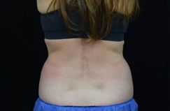 CoolSculpting™ Before