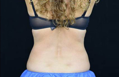 After CoolSculpting® Results