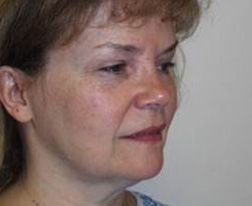 Before Facelift Results