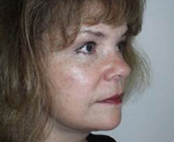 After Facelift Results