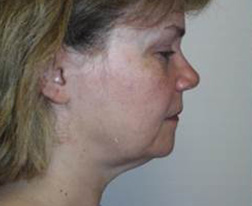 Facelift Before