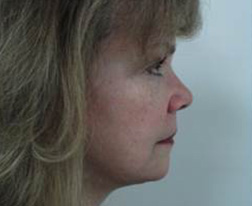 After Facelift Results