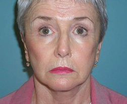 After Facelift Results cosmetic plastic surgery New Jersey
