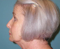 Before Facelift Results