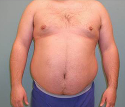 Liposuction Before