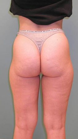 Liposuction Before