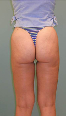 After Liposuction Results