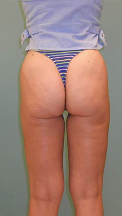 Liposuction After