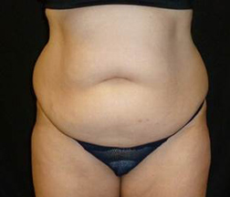 Liposuction Before