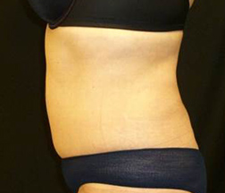 Liposuction After