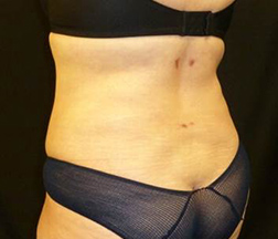 Liposuction After