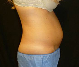 Liposuction Before