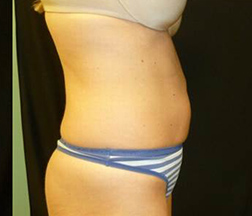 Liposuction After