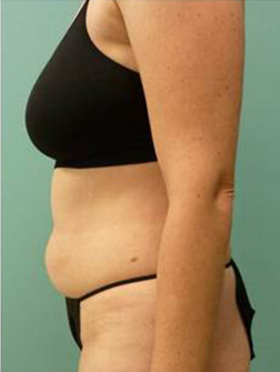 Liposuction Before