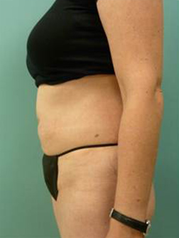 After Liposuction Results