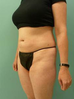 Liposuction After