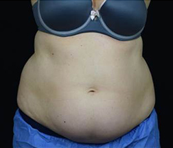 Liposuction Before