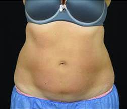 Liposuction After