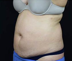 Liposuction Before