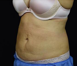 Liposuction After