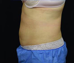 Liposuction After