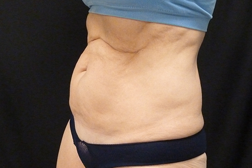 Liposuction Before