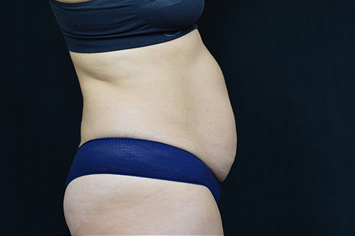 Liposuction Before