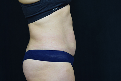 Liposuction After