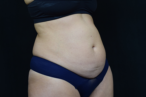 Liposuction Before