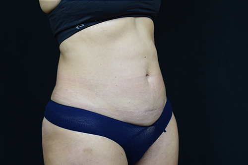 Liposuction After