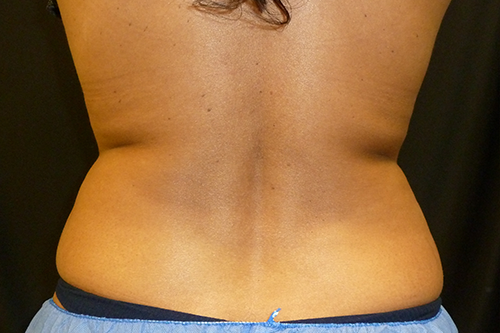 Liposuction Before