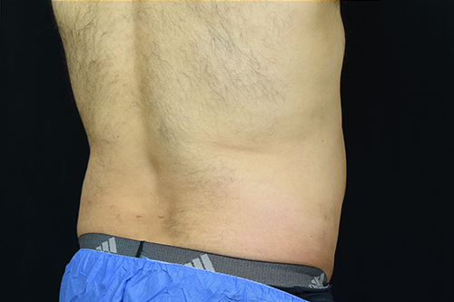 Liposuction After