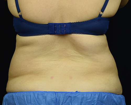 Liposuction After
