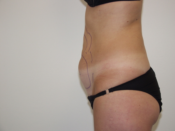 SmartLipo™ Before