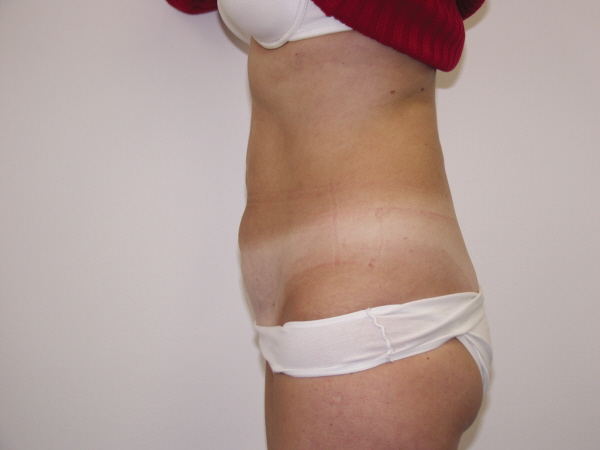 SmartLipo™ After