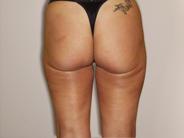 SmartLipo™ After