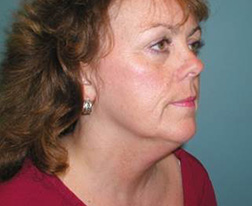Before Neck Lift Results